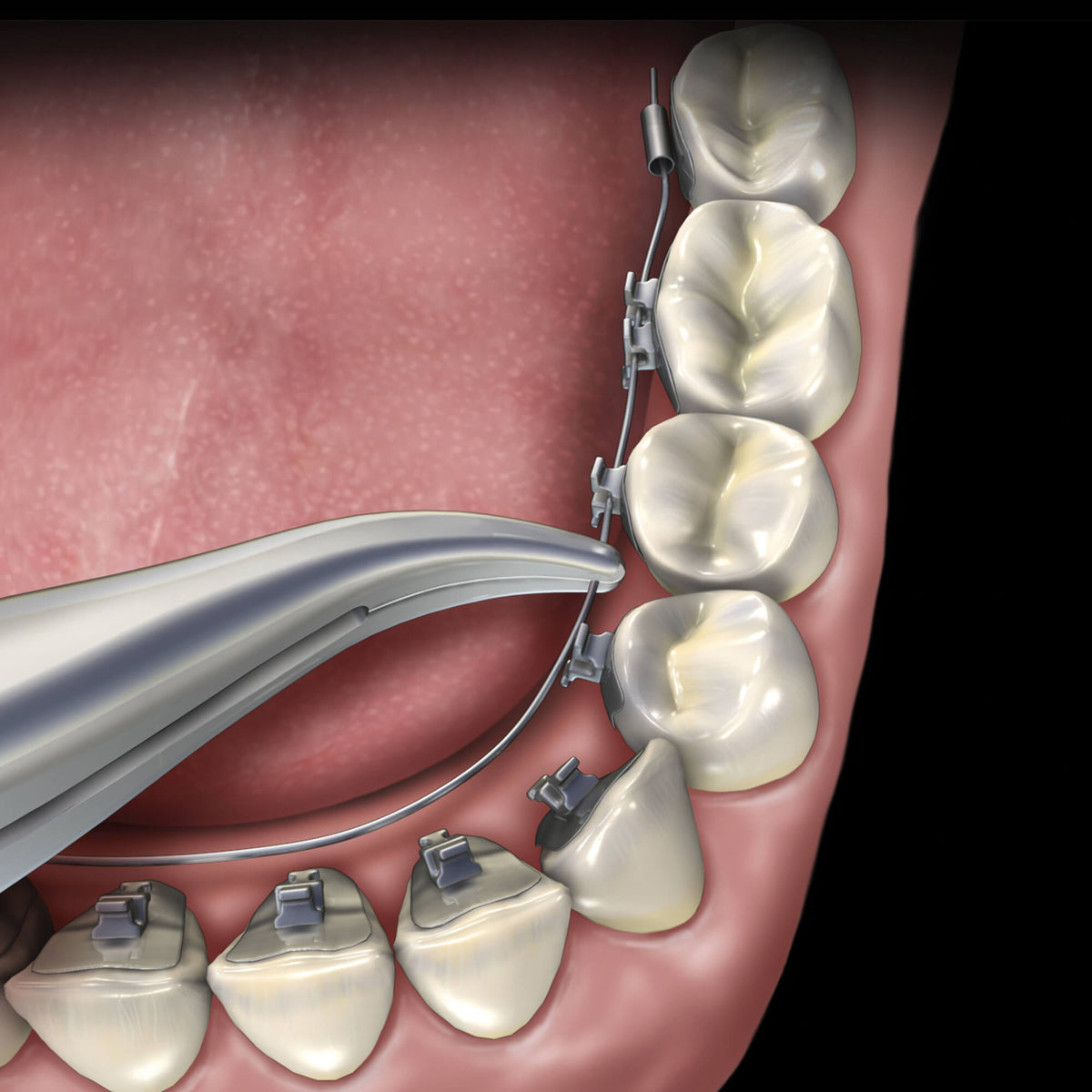 Lingual Weingart Pliers